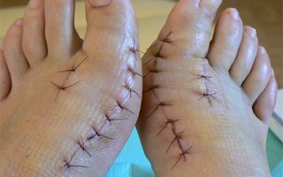 Хирургическое удаление косточки на ноге: операция и послеоперационный период