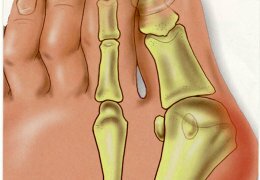 Косточка у большого пальца ноги болит и растет: что делать и как лечить