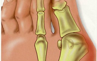 Косточка у большого пальца ноги болит и растет: что делать и как лечить