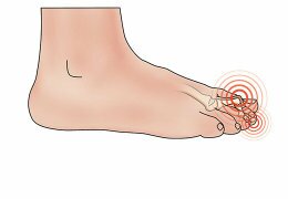Причины появления нароста на ноге у большого пальца и методы его удаления