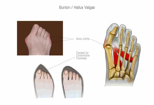 косточка на ноге