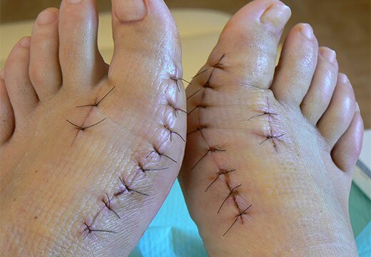 Швы на халюс вальгус