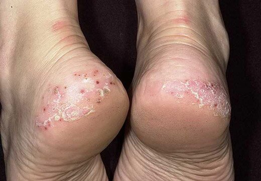 Псориаз ног